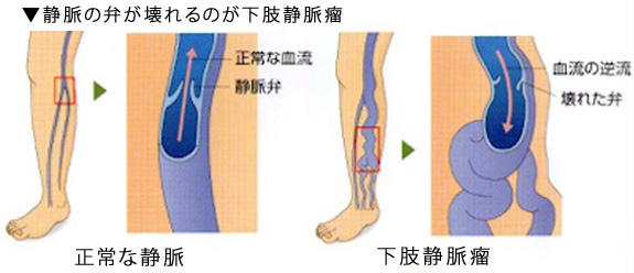 下肢静脈瘤ってどんな病気？