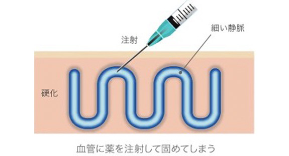 硬化療法