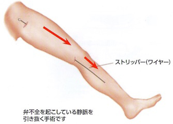 手術（ストリッピング手術）